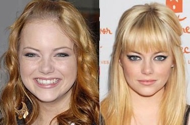 A picture of Emma Stone before (left) and after (right).